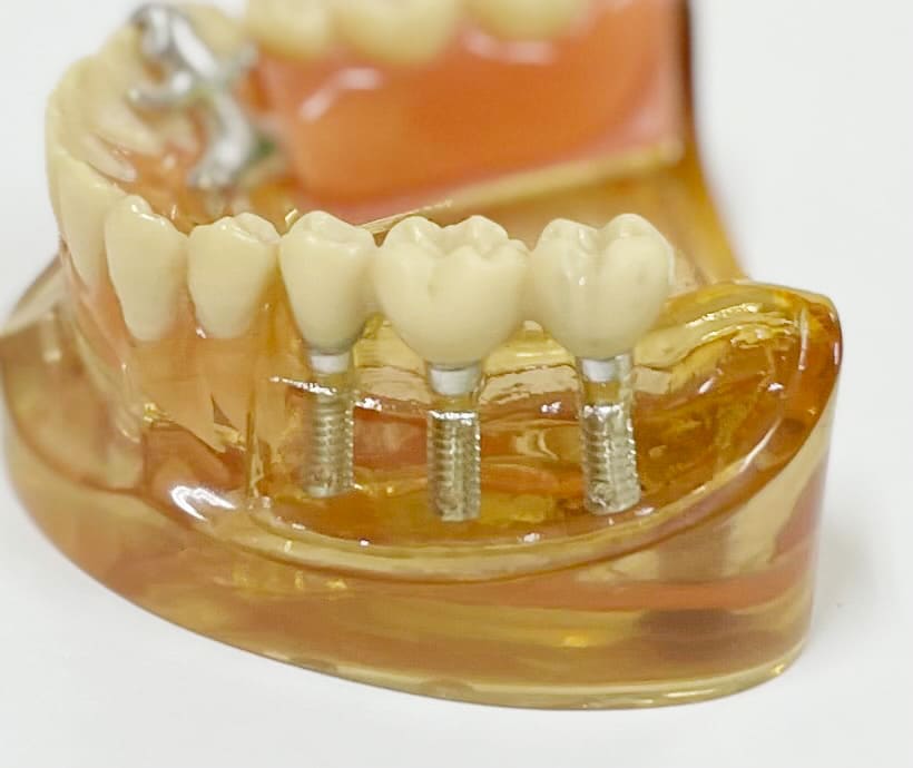 天然の歯のような噛み心地を実現するインプラント治療