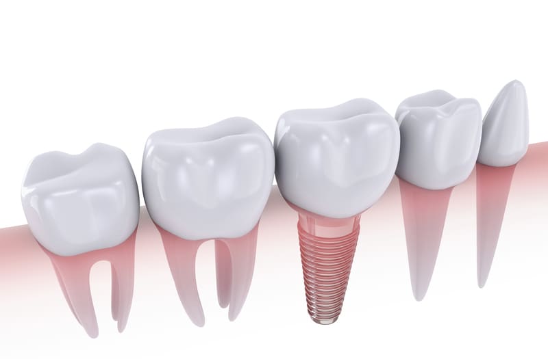 当院では日本人の歯に適合しやすいオステムインプラントを採用しています